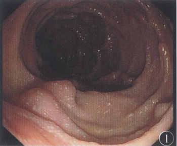 胶囊内镜示全小肠黏膜肿胀,呈广泛散在白斑样改变(图2).