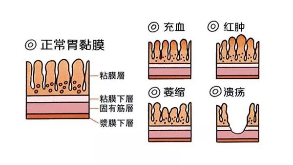 胃黏膜由上皮,固有层及粘膜肌层组成.